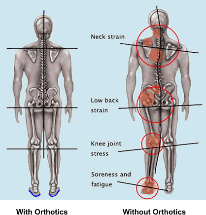 Body-Alignment-with-and-without-Orthotics virtual fit orthotics custom made